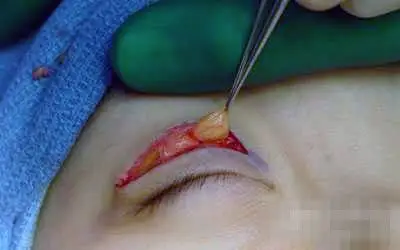 割双眼皮去脂肪全过程(组图)(2)