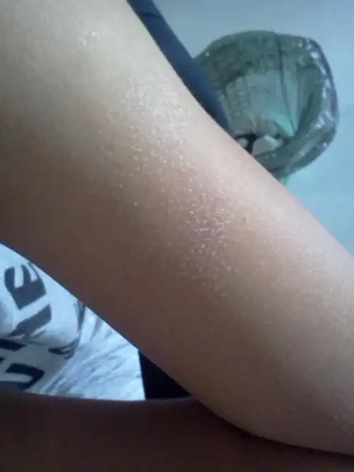 鸡皮肤是天生的彻底治愈对比图片