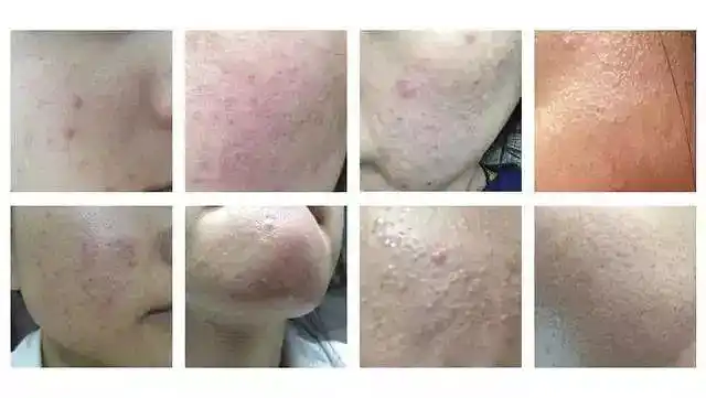 怎么才能修复受损皮肤屏障?