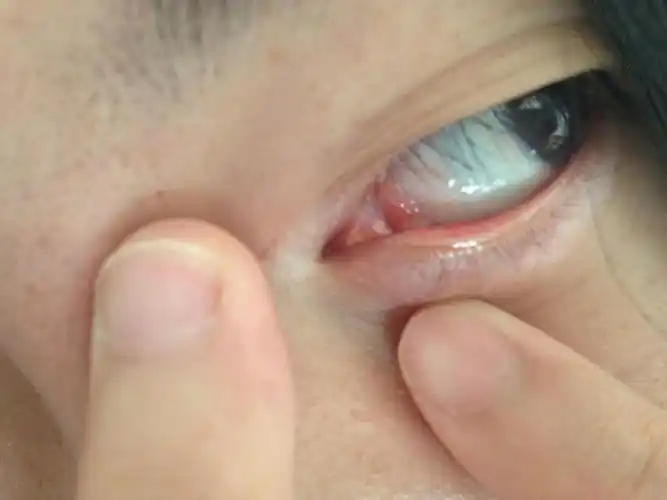 内眦长了一个白点