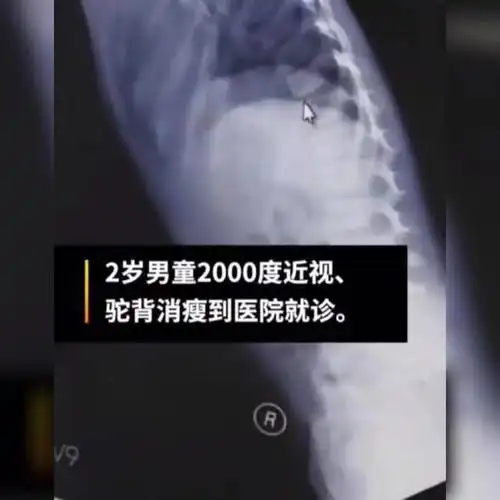 2岁男孩近视两千多度,被确诊为马凡综合征:患病率低于万分之一