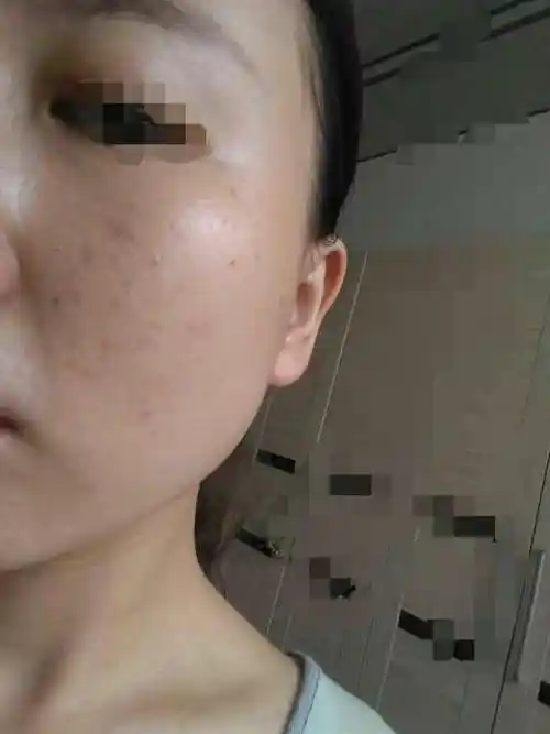 面部过敏又长痘痘怎么办?咨询分析_纪秀军_主任医师_爱问健康