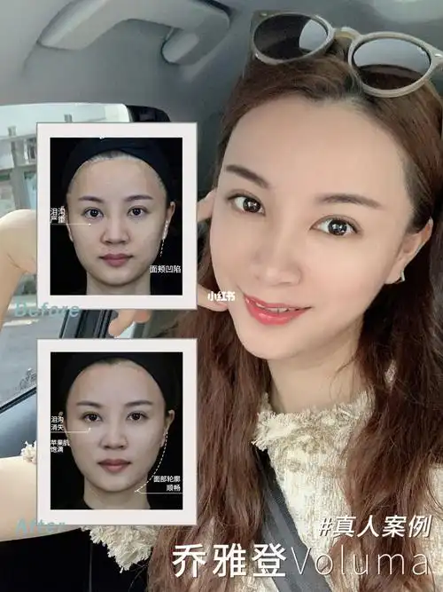 苹果肌填充对比图_苹果肌_美妆_医美整形