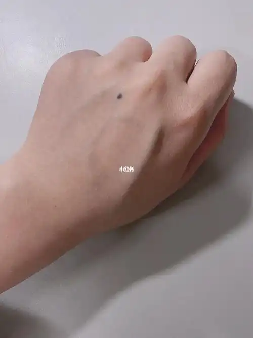 手背长出来的痣