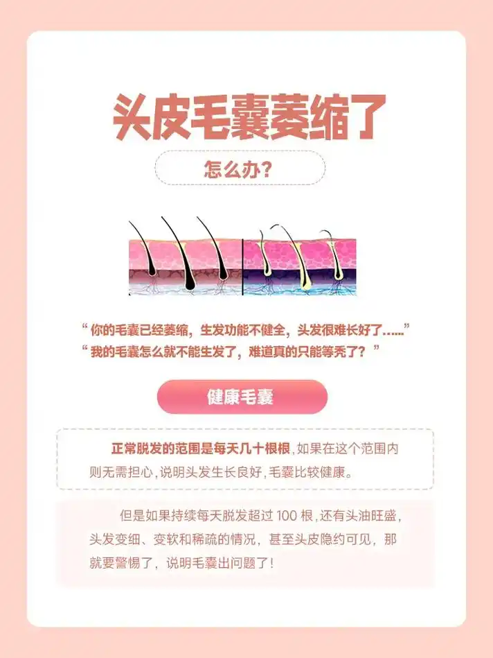 头皮毛囊萎缩了怎么办? 脱发的人是不是 - 抖音