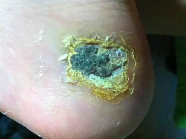 伤口结痂愈合问题!答案满意追加分数.