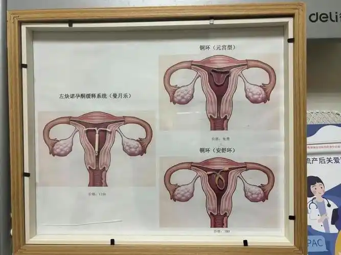 54岁的妈妈,"28岁"的节育环