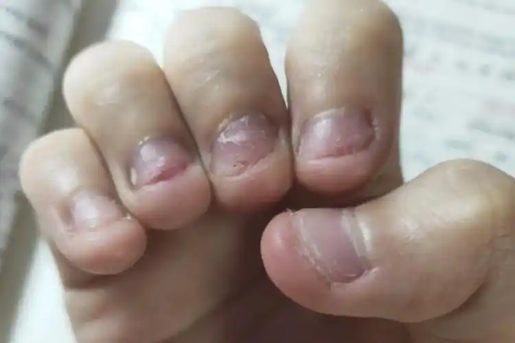 习惯性咬指甲的患者通常会在不经意间反复的啃咬指甲,所以这些人群的