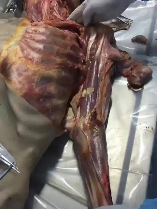 庞继光教授亲自授课:微创针刀新鲜尸体解剖与模拟临床操作实训高级