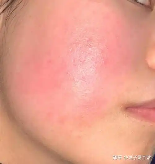 脸上有红血丝皮肤容易过敏有什么护肤品可以推荐吗