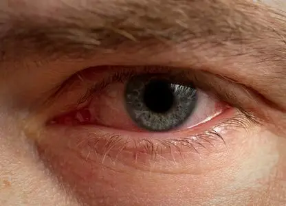 眼睛开始出现血丝图片-眼睛开始出现血丝素材-眼睛开始出现血丝插画