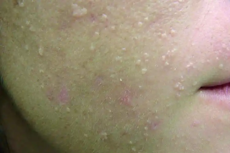 扁平疣的早期症状是在病变的部位出现米粒大小的皮肤颜色或者淡褐色的