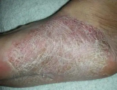 真菌性皮炎怎么引起,自从用了这个方法,三生三世都不会再长