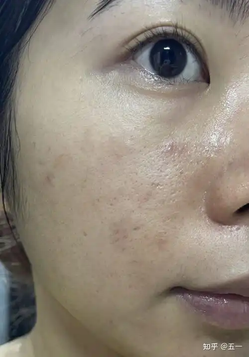 脸颊泛红,油腻,毛孔粗大——脂质型大毛孔应该怎么解决? - 知乎