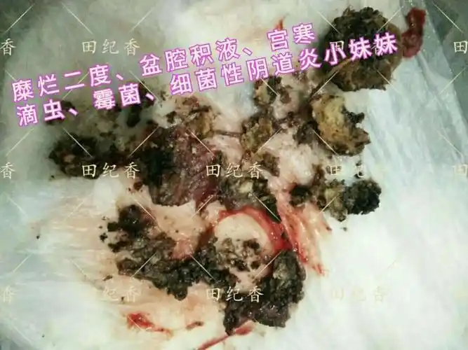 妇科炎症的一个走向