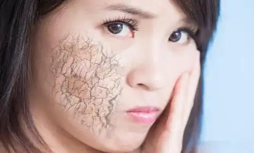冬季皮肤干燥敏感_冬季皮肤干燥是怎么回事,皮肤干燥要怎么缓解