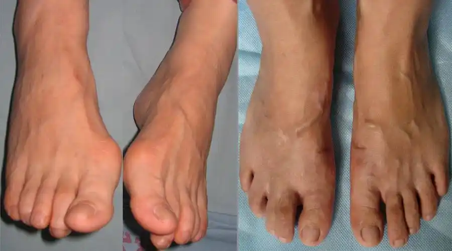 大脚骨的治疗效果图 - 好大夫在线