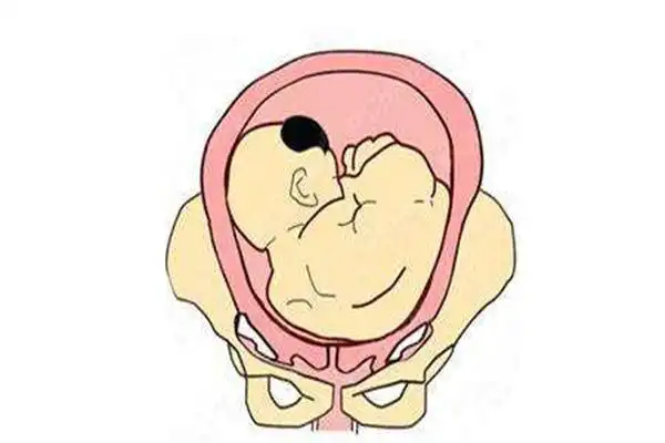 持续性枕横位能顺产么 持续性枕横位的预防方法