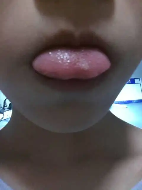 舌头上有块很大块的溃疡,,喷了西瓜霜也好不了.