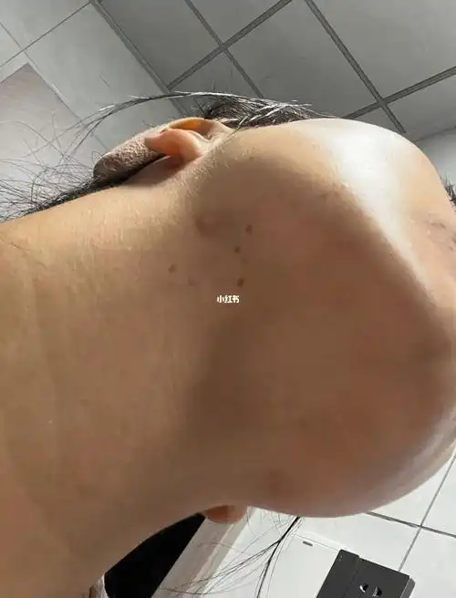 下颌线与脖子交界处长的痘痘是为什么