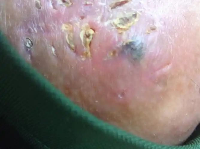 2014-02-14 王康 医师 包皮手术已经拆线了两天了,我今天洗澡,拆了