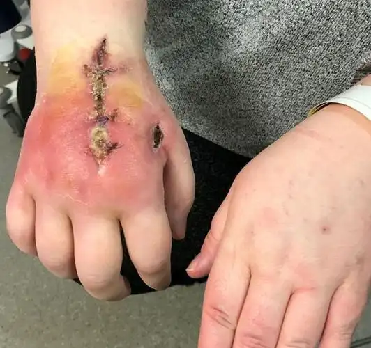 由于她的猫咬了一下她几乎失去了她的手,但她也不打算离开她的猫