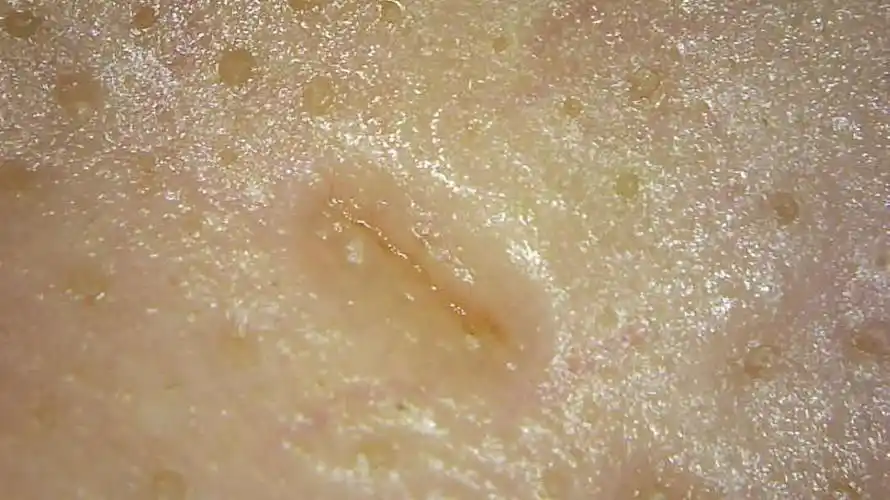 显微镜下的皮肤毛孔(一年对比改善)