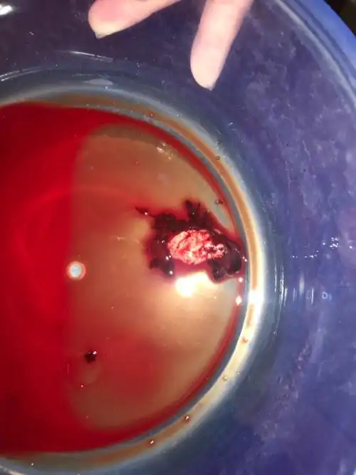 怀孕40天 药流吃药 第三天早晨 尿出来的.请问这是胎囊吗?