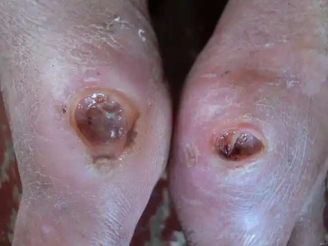 慢性皮肤溃疡就不愈合 - 中医临床经验版 - 爱爱医医学论坛