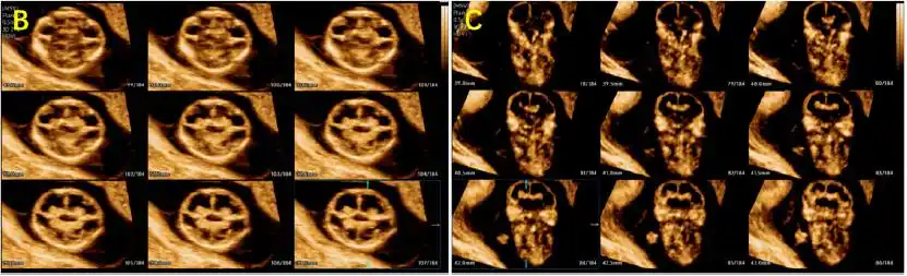然而不幸的是, 12 周时超声显示单绒双羊三胎妊娠,其一羊膜囊内为正常