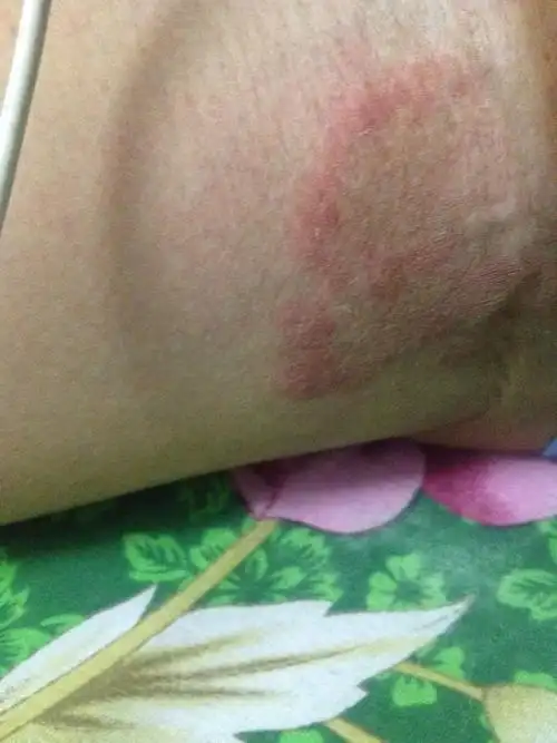 大腿内侧根部,要是发红了就会有点痛痒,什么皮肤病,?