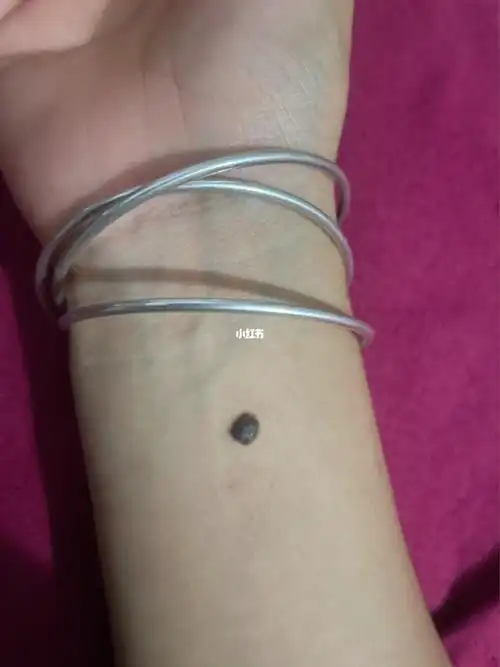 最近老看到有小红薯宝宝发手腕的痣 我也跟个风发下 是不是长的很正小