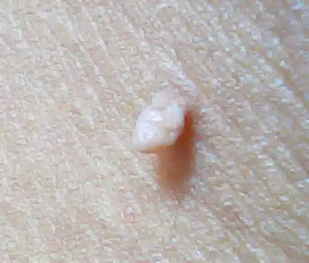 我们在生活中会肯定有见过,有些人皮肤的某个部位长出一个小肉瘤