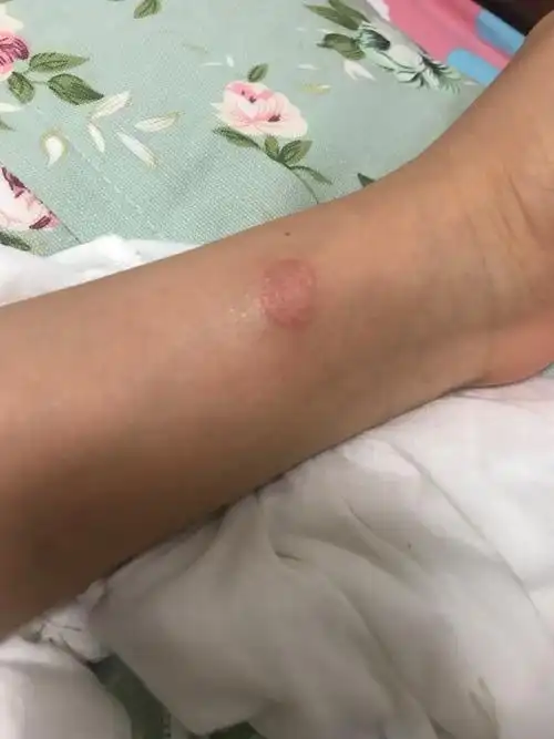 关于铜钱癣的初期发展治疗好转