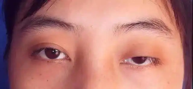 眼睑下垂有什么办法改善