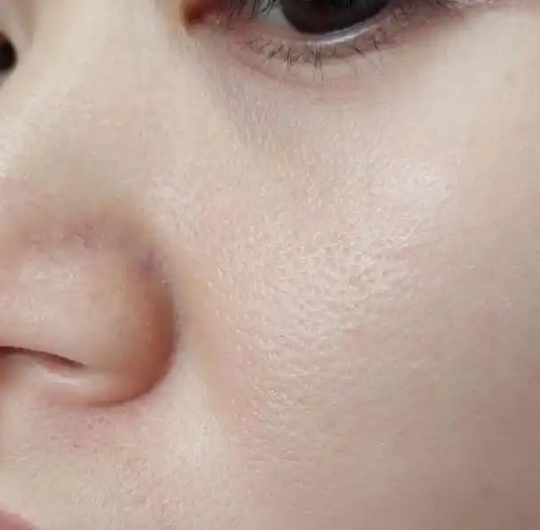 第二:由于缺水而导致的毛孔粗大