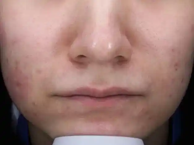 从内到外到医美毛孔粗大的解决方案都在这里真人实例