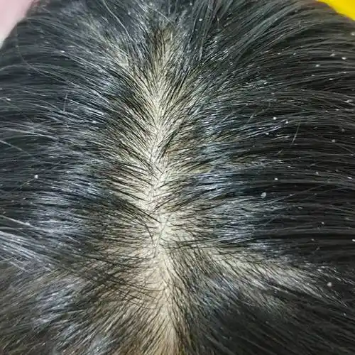 头上毛囊炎用什么洗头发