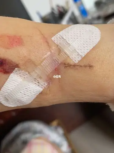 切纹身术后第24天_美妆_医美_整容_美妆_医美整形