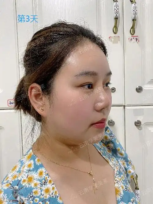 现在是刚打完玻尿酸填充泪沟的第三天,基本没有什么不适的症状了,没有