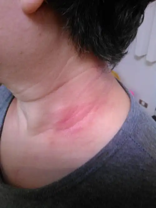 脖子起大块红斑(如图),很痒,天气凉了就强点,天气热就严重,是什么啊?