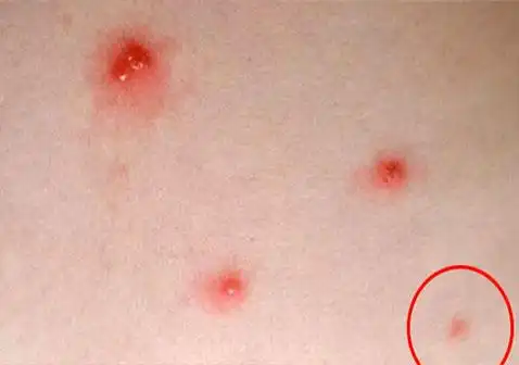 水痘早期图片大全-阅知家养生网