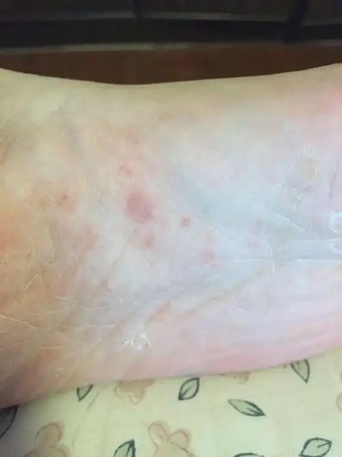 最近脚底板长了很多这样像水泡的红点,但都在皮肤下面,摸得到,但不好