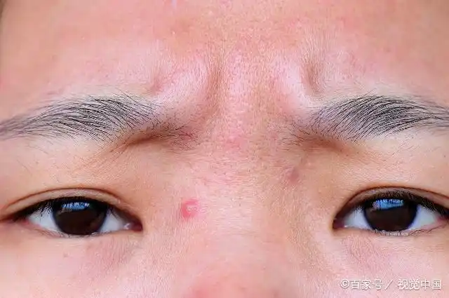 过度敷面膜会导致水合性皮炎吗?