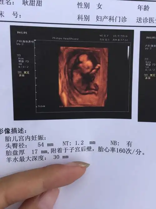 三个月做的nt 这是男孩还是女孩?