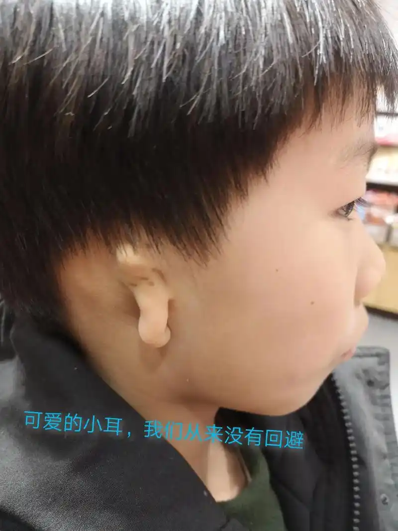 耳廓整形#小耳整形#单耳畸形,术后一年了,每段经历都是一种 - 抖音