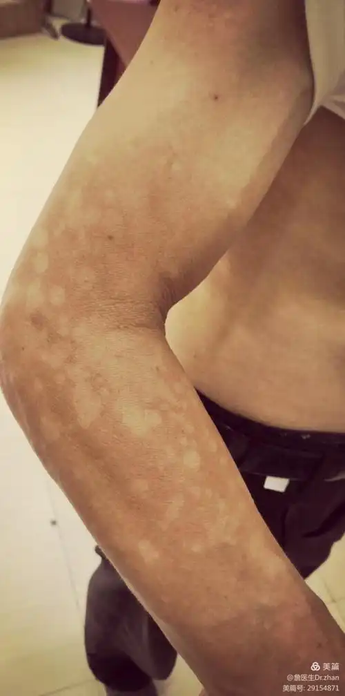 其它 花斑糠疹是不是汗斑 写美篇花斑糠疹是一种常见的皮肤真菌感染性