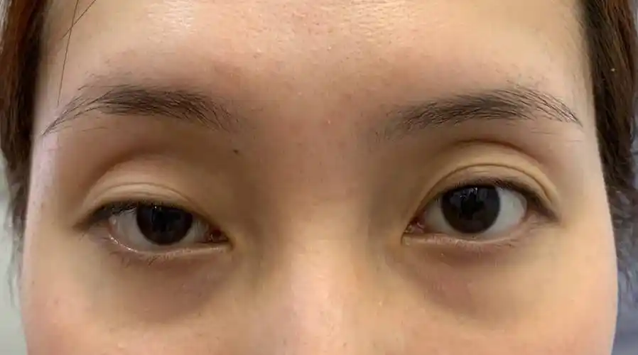 解析好看双眼皮美学标准 整形医生田鑫