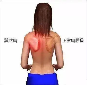 前锯肌|肌肉|肩胛|翼状|斜方肌_网易订阅