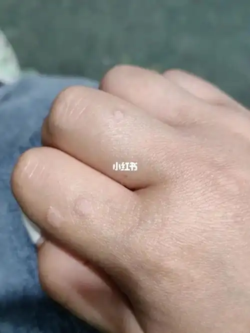 手上有扁平疣怎么治好,之前只有一个,现在三个人了,之前擦了药也没有